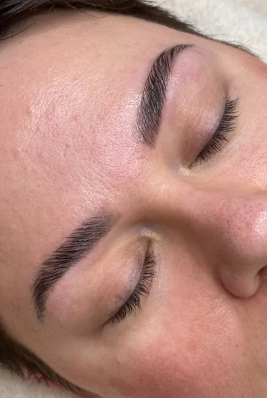 Brow Lifting